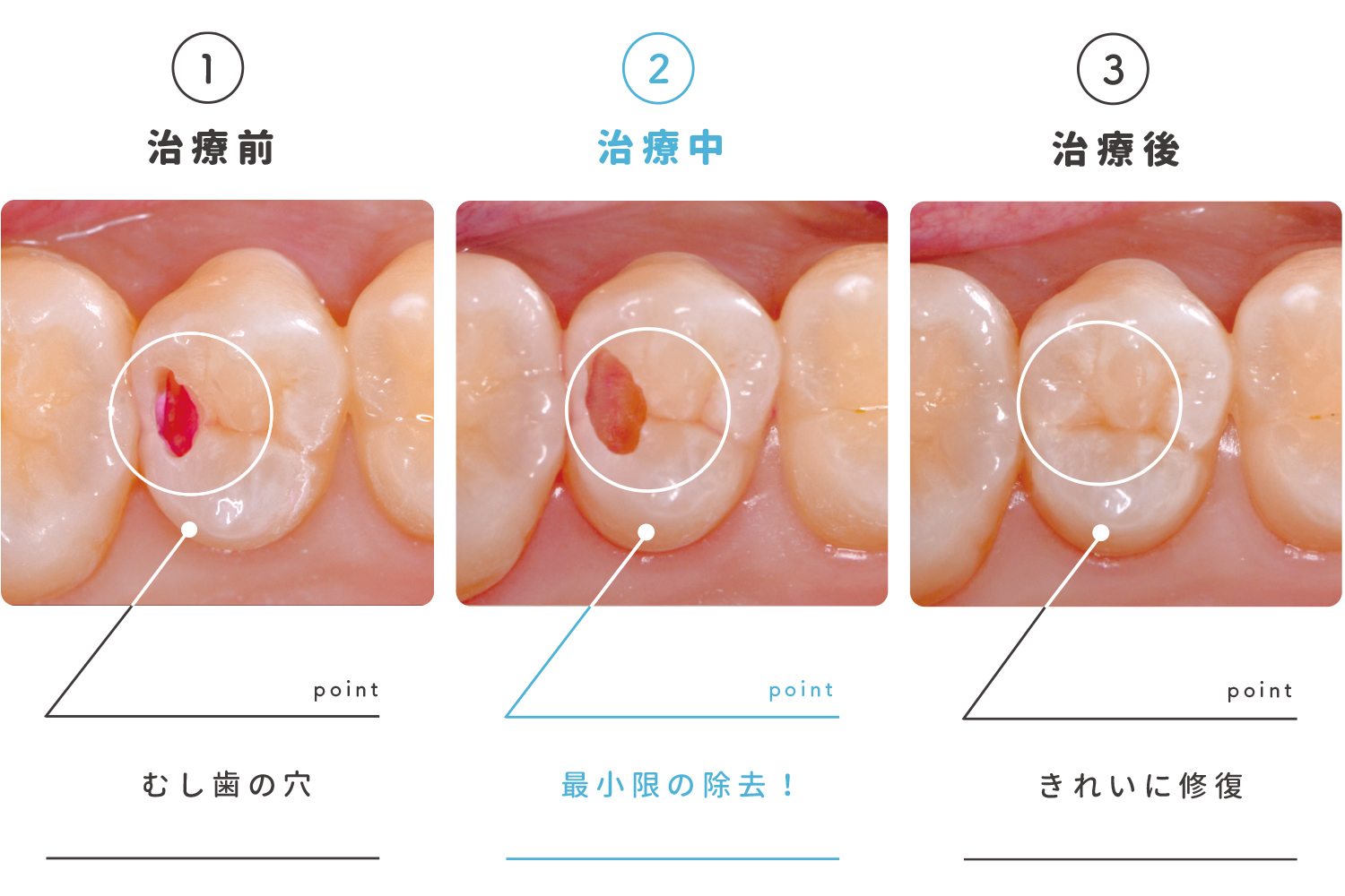 むし歯は早期発見、解決をすることが最も大切となります